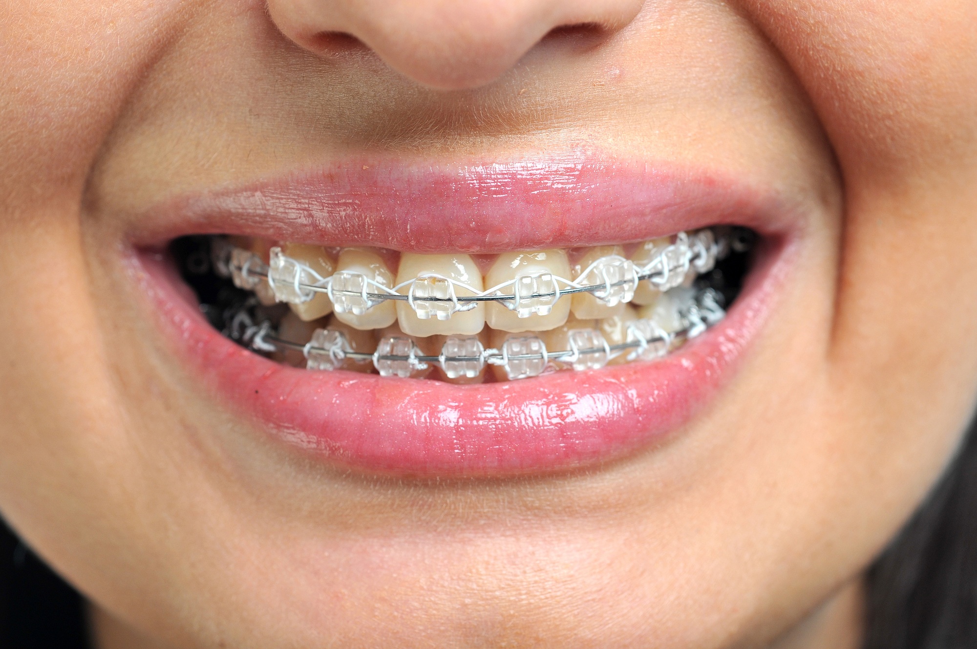 Close-up of ceramic and metallic braces on teeth. Orthodontic Treatment. Dental Care Concept