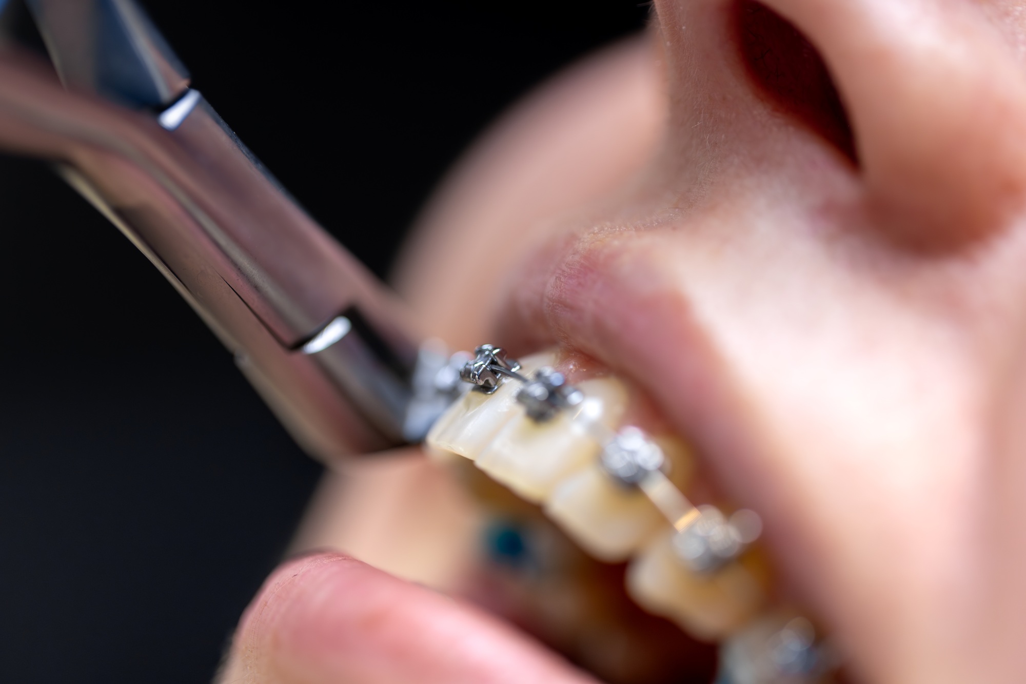 Dental procedure for installing braces close up. Dentistry. Braces on the teeth.