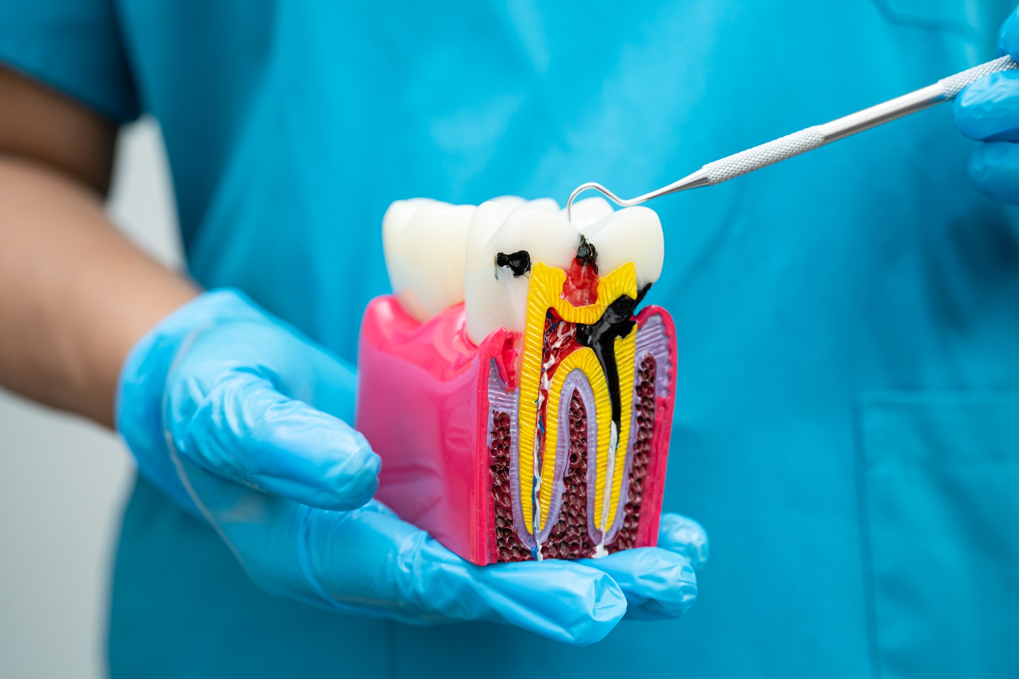 Asian dentist holding dental implant, artificial tooth roots into jaw, root canal