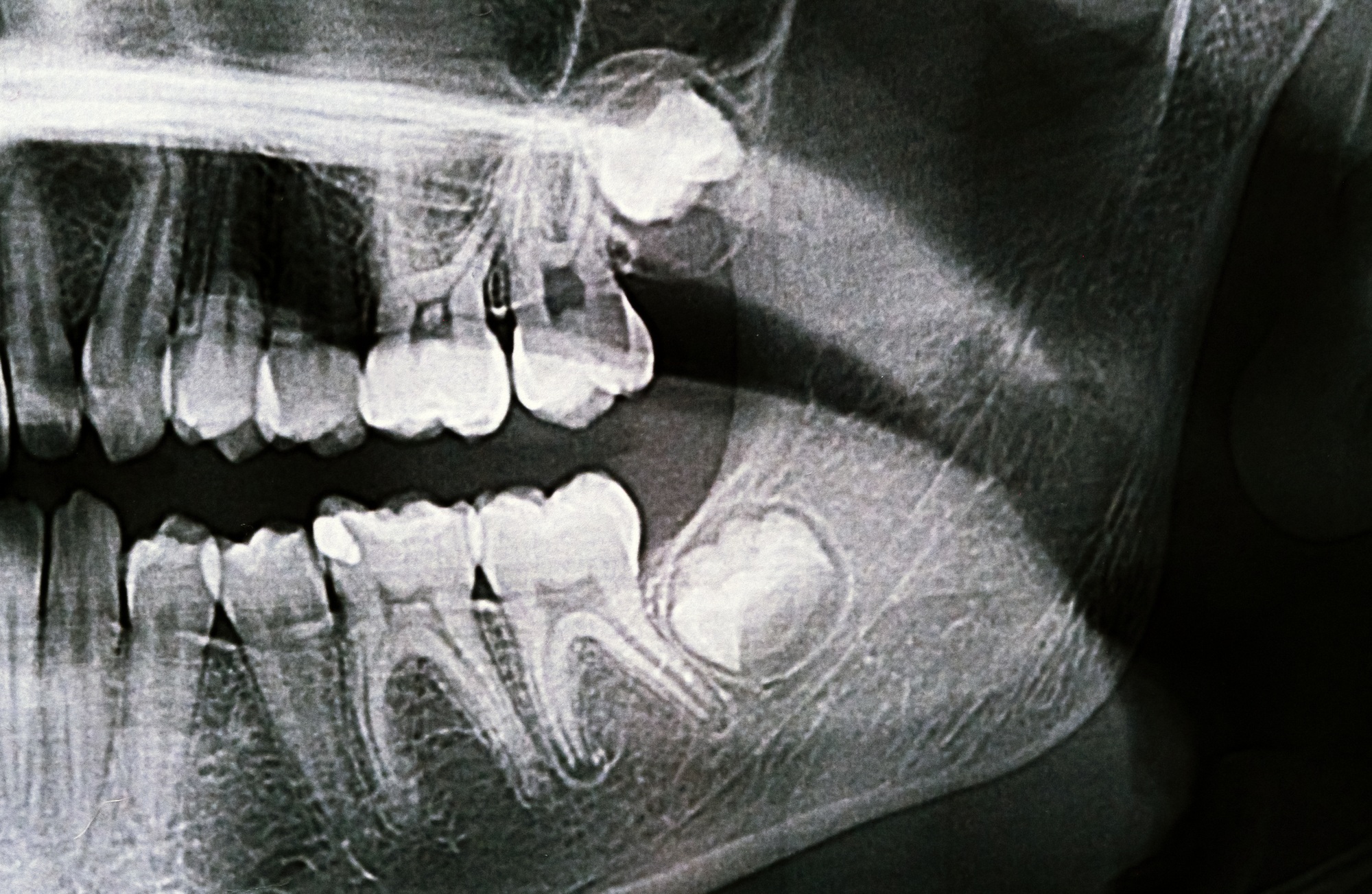 Panoramic X-ray of the jaw. X-ray of the teeth of a 12-year-old girl