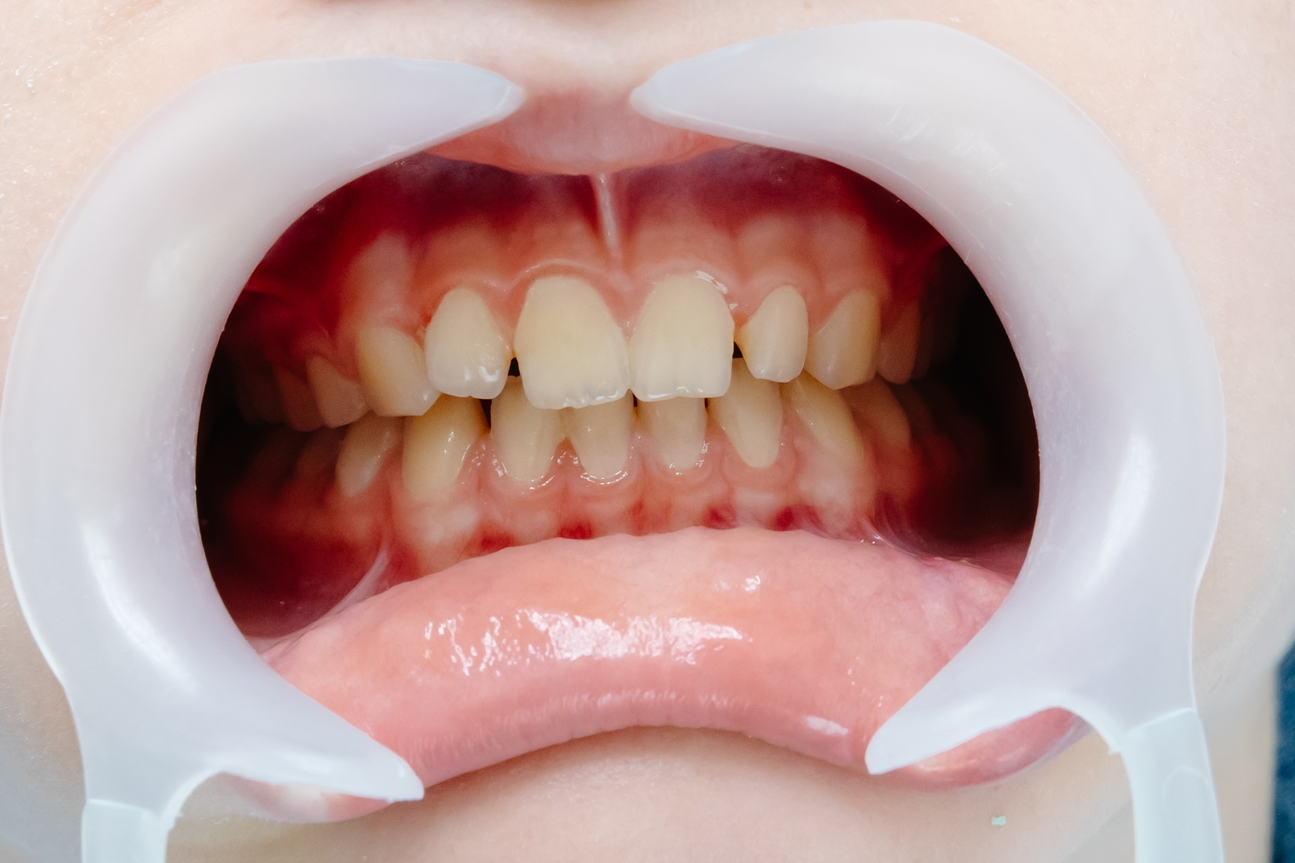 Caucasian girl with braces on her teeth looking at the mirror.