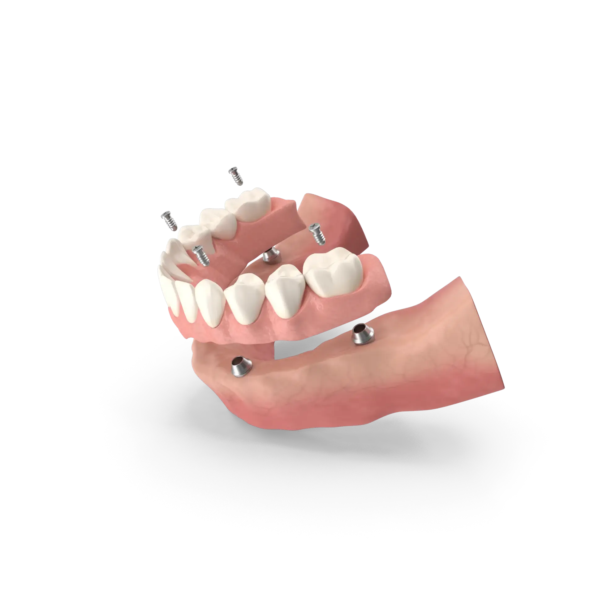 Implant20Supported20Denture.G04.2k (2)