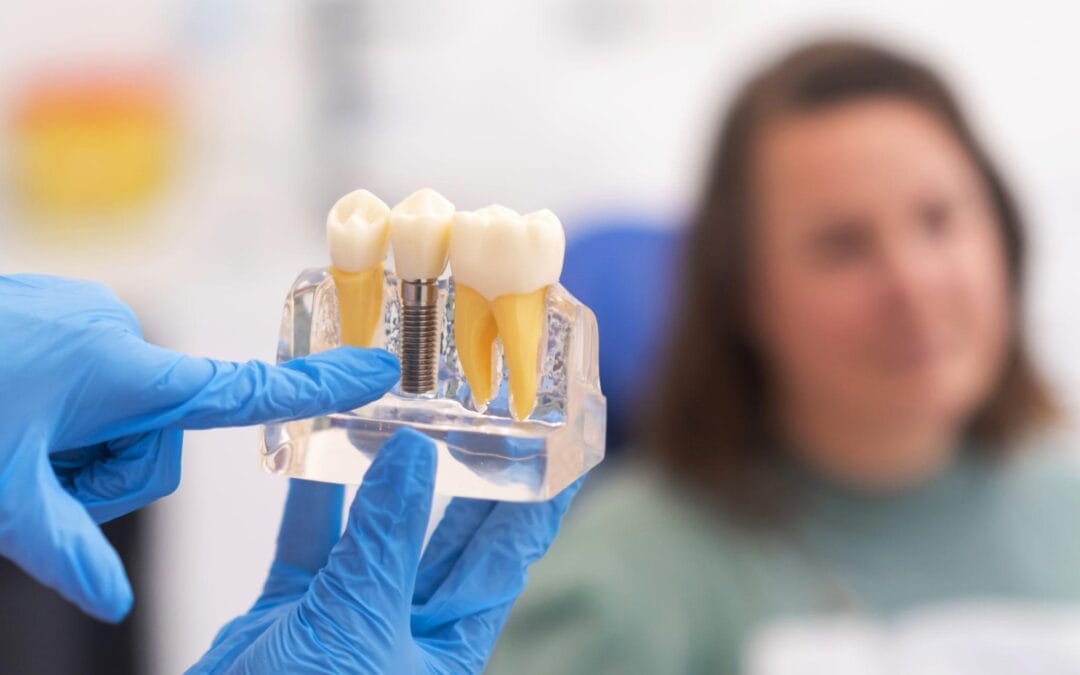 All on 4 Implants vs. Traditional Implants – Which Option Is Right for You