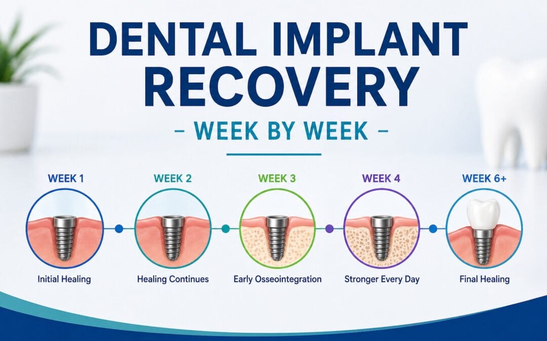 Dental Implant Recovery – Week by Week