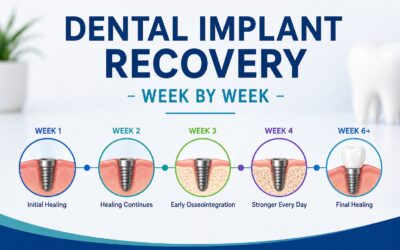 Dental Implant Recovery – Week by Week