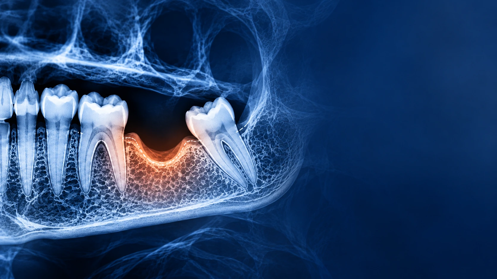 Dental x-ray used in bone grafting treatment planning at Bright Smiles