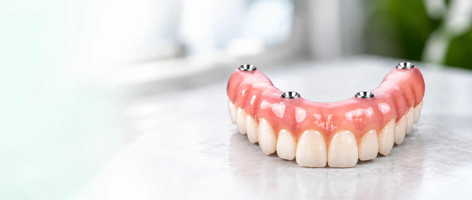 Full-arch implant-supported dental prosthesis