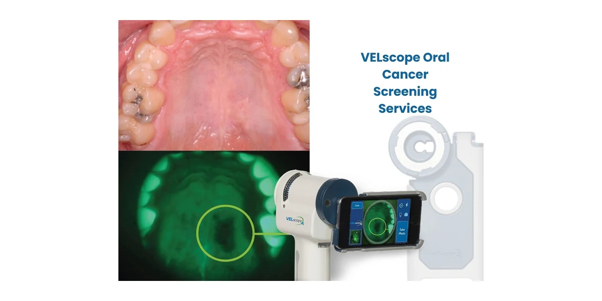 VELscope oral screening device with clinical fluorescence images